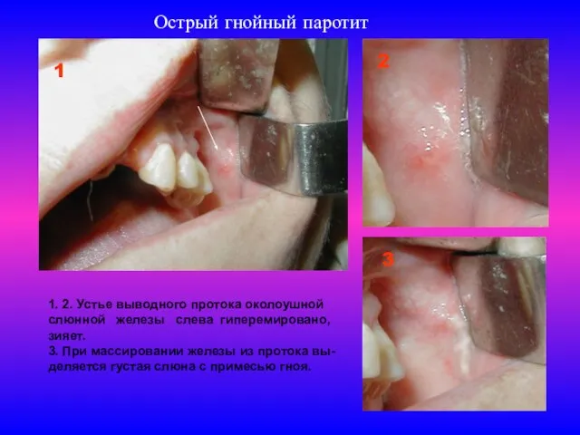 Острый гнойный паротит 1 2 3 1. 2. Устье выводного протока околоушной