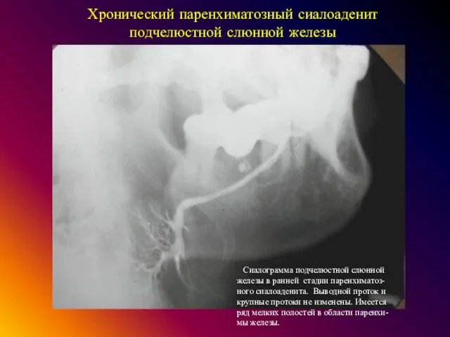 Хронический паренхиматозный сиалоаденит подчелюстной слюнной железы Сиалограмма подчелюстной слюнной железы в ранней