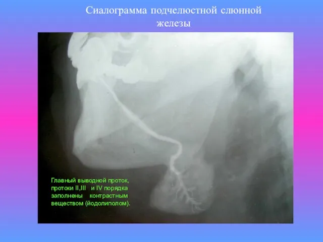 Сиалограмма подчелюстной слюнной железы Главный выводной проток, протоки II,III и IV порядка заполнены контрастным веществом (йодолиполом).