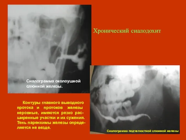 Хронический сиалодохит Контуры главного выводного протока и протоков железы неровные, имеются резко