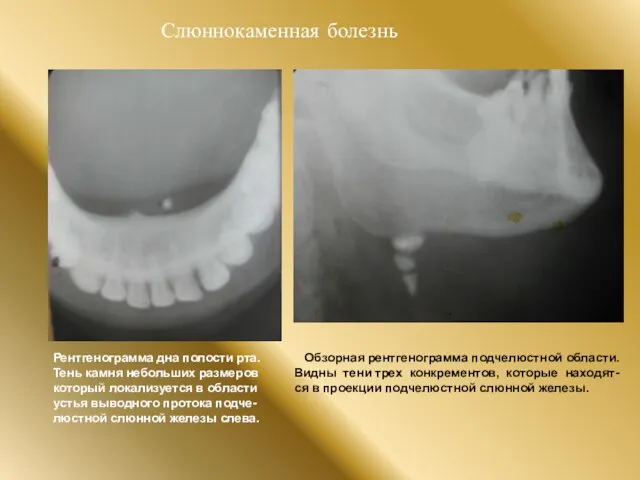 Слюннокаменная болезнь Рентгенограмма дна полости рта. Тень камня небольших размеров который локализуется