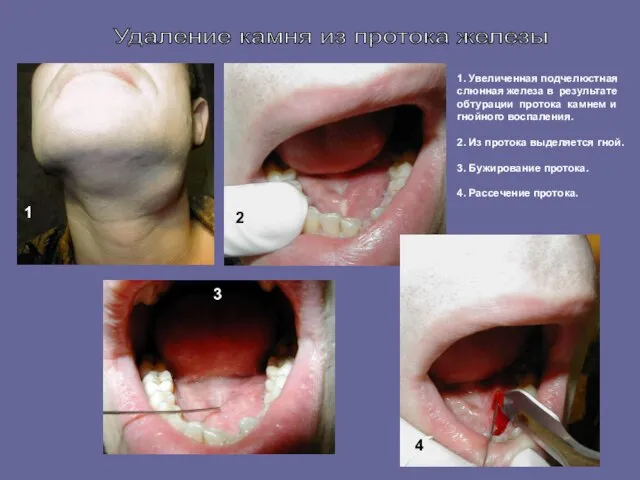 Удаление камня из протока железы 1 2 3 4 1. Увеличенная подчелюстная