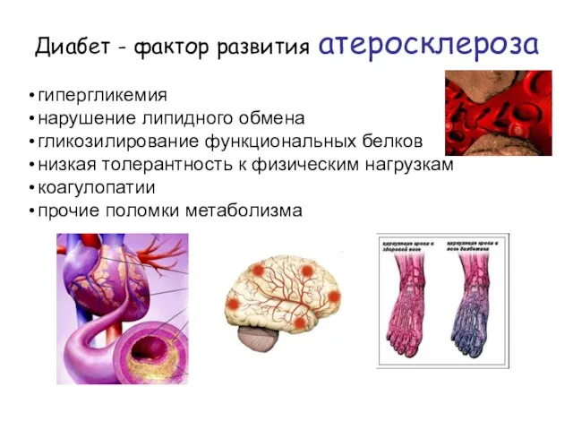 Диабет - фактор развития атеросклероза гипергликемия нарушение липидного обмена гликозилирование функциональных белков