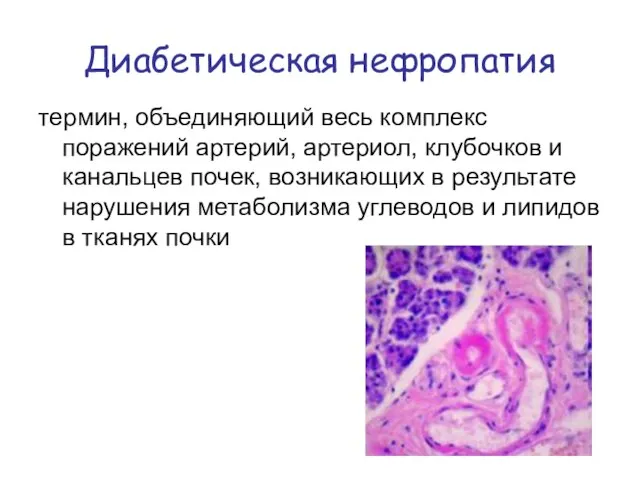 Диабетическая нефропатия термин, объединяющий весь комплекс поражений артерий, артериол, клубочков и канальцев