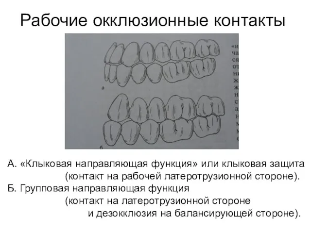 Рабочие окклюзионные контакты А. «Клыковая направляющая функция» или клыковая защита (контакт на