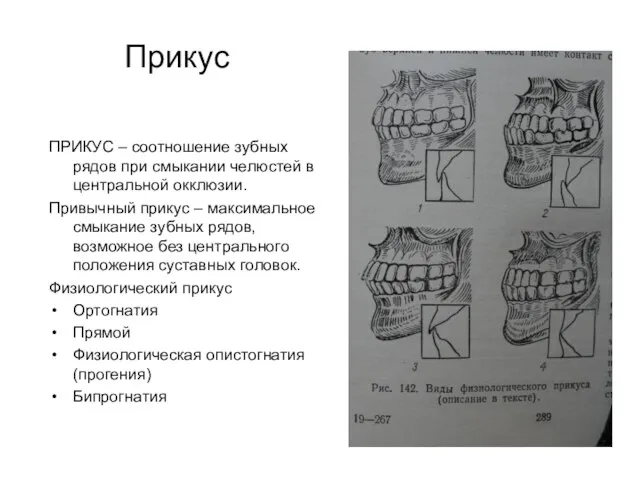 ПРИКУС – соотношение зубных рядов при смыкании челюстей в центральной окклюзии. Привычный