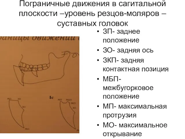 Пограничные движения в сагитальной плоскости –уровень резцов-моляров –суставных головок ЗП- заднее положение