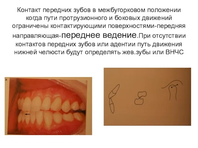 Контакт передних зубов в межбугорковом положении когда пути протрузионного и боковых движений