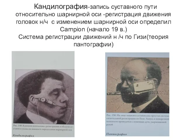 Кандилография-запись суставного пути относительно шарнирной оси -регистрация движения головок н/ч с изменением