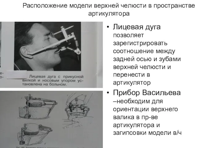 Расположение модели верхней челюсти в пространстве артикулятора Лицевая дуга прибор Васильева Лицевая