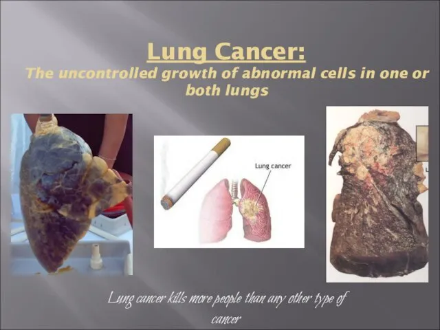 Lung Cancer: The uncontrolled growth of abnormal cells in one or both