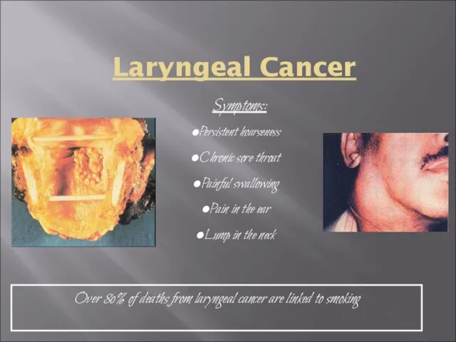 Laryngeal Cancer Symptoms: Persistent hoarseness Chronic sore throat Painful swallowing Pain in