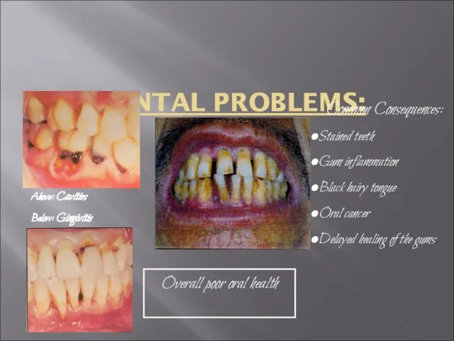 DENTAL PROBLEMS: Above: Cavities Below: Gingivitis Overall poor oral health Common Consequences:
