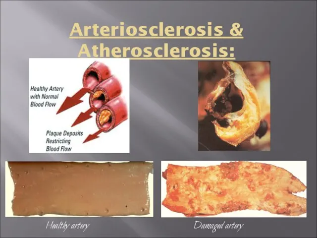 Arteriosclerosis & Atherosclerosis: Healthy artery Damaged artery