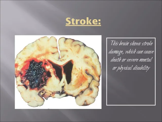 Stroke: This brain shows stroke damage, which can cause death or severe mental or physical disability