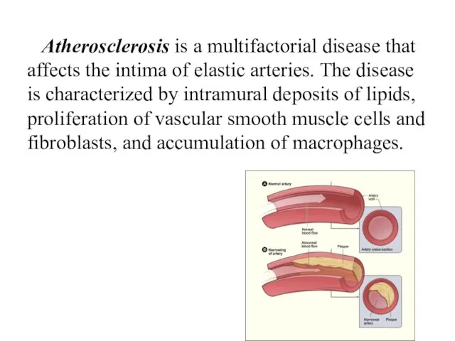 Atherosclerosis is a multifactorial disease that affects the intima of elastic arteries.