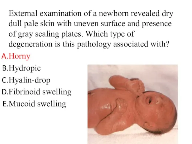 External examination of a newborn revealed dry dull pale skin with uneven