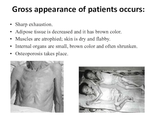 Gross appearance of patients occurs: Sharp exhaustion. Adipose tissue is decreased and