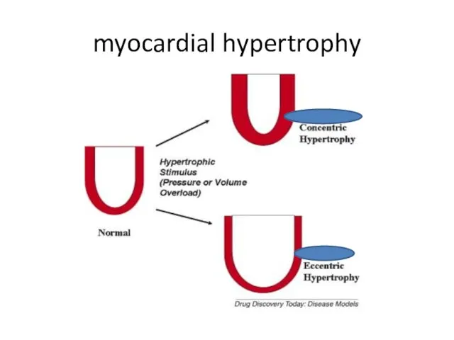 myocardial hypertrophy