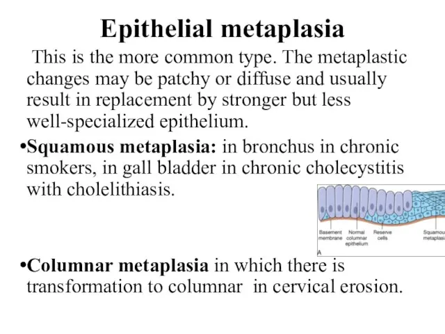 Epithelial metaplasia This is the more common type. The metaplastic changes may