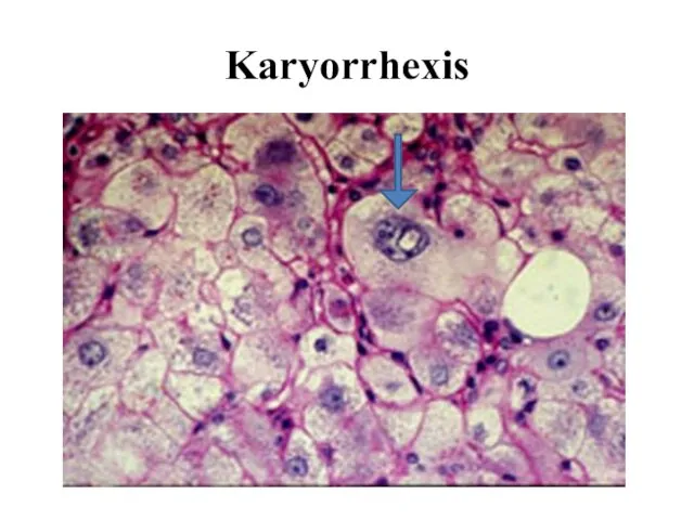 Karyorrhexis