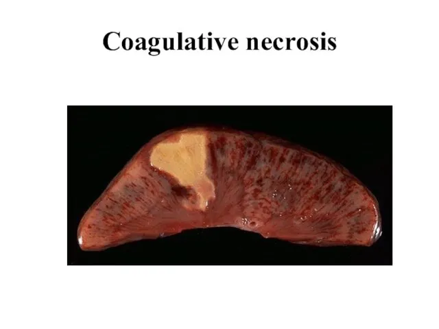 Coagulative necrosis