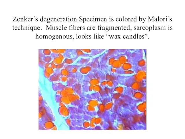 Zenker’s degeneration.Specimen is colored by Malori’s technique. Muscle fibers are fragmented, sarcoplasm