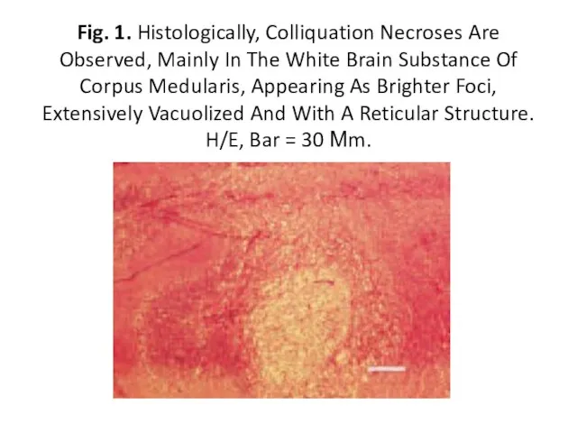 Fig. 1. Histologically, Colliquation Necroses Are Observed, Mainly In The White Brain