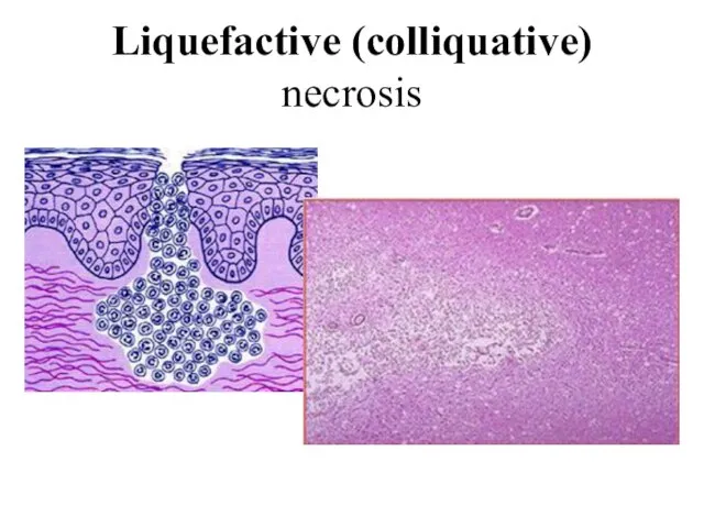 Liquefactive (colliquative) necrosis