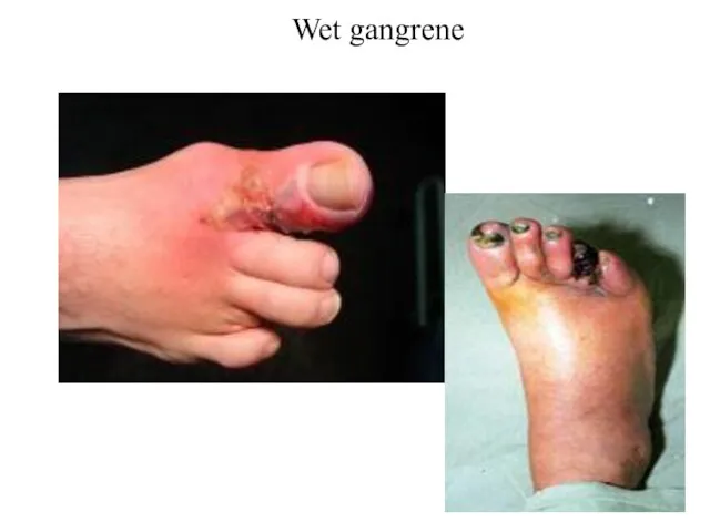 Wet gangrene