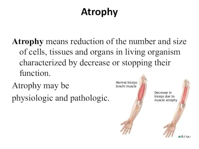 Atrophy Atrophy means reduction of the number and size of cells, tissues