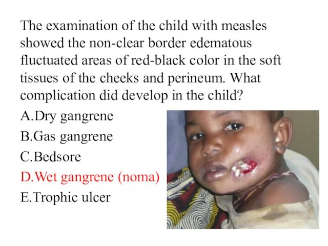 The examination of the child with measles showed the non-clear border edematous
