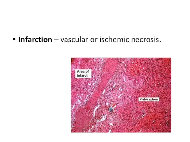 Infarction – vascular or ischemic necrosis.