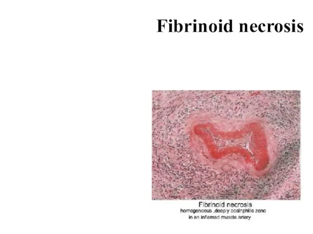 Fibrinoid necrosis