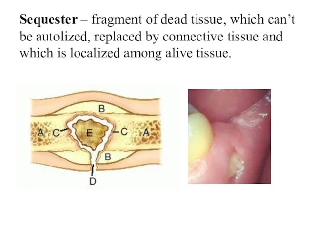 Sequester – fragment of dead tissue, which can’t be autolized, replaced by