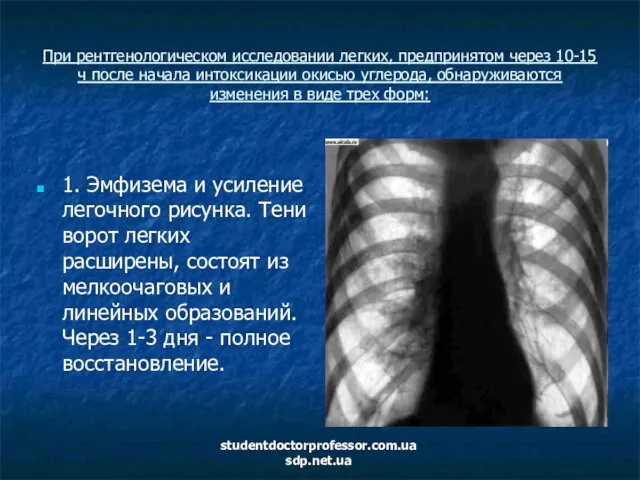 При рентгенологическом исследовании легких, предпринятом через 10-15 ч после начала интоксикации окисью