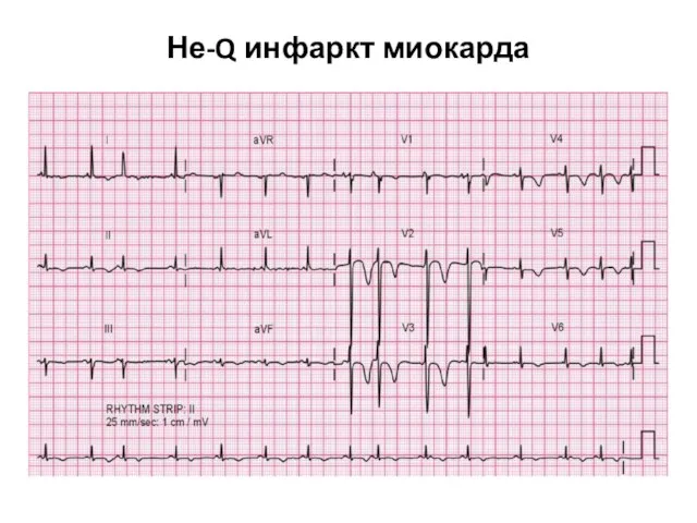 Не-Q инфаркт миокарда