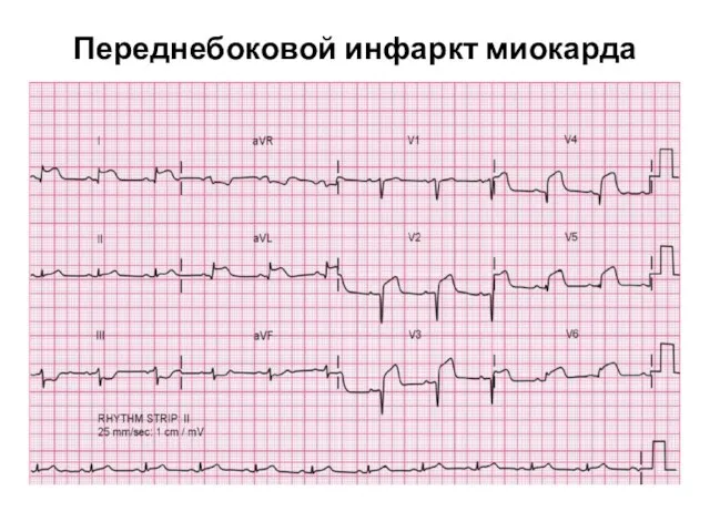 Переднебоковой инфаркт миокарда