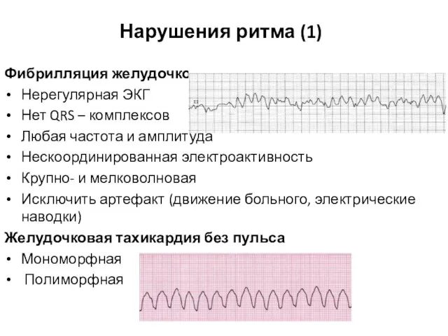 Нарушения ритма (1) Фибрилляция желудочков Нерегулярная ЭКГ Нет QRS – комплексов Любая