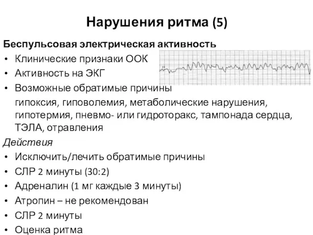 Нарушения ритма (5) Беспульсовая электрическая активность Клинические признаки ООК Активность на ЭКГ