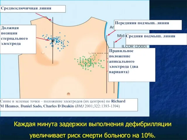 Каждая минута задержки выполнения дефибрилляции увеличивает риск смерти больного на 10%.