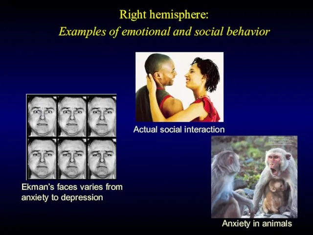 Actual social interaction Ekman’s faces varies from anxiety to depression Right hemisphere: