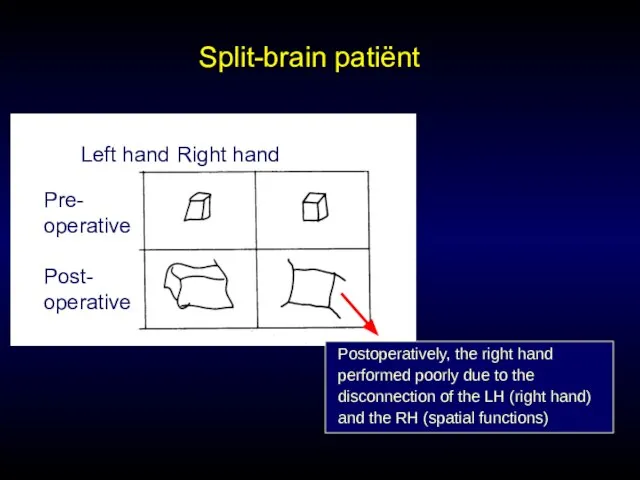 Split-brain patiënt Left hand Right hand Pre- operative Post- operative Postoperatively, the