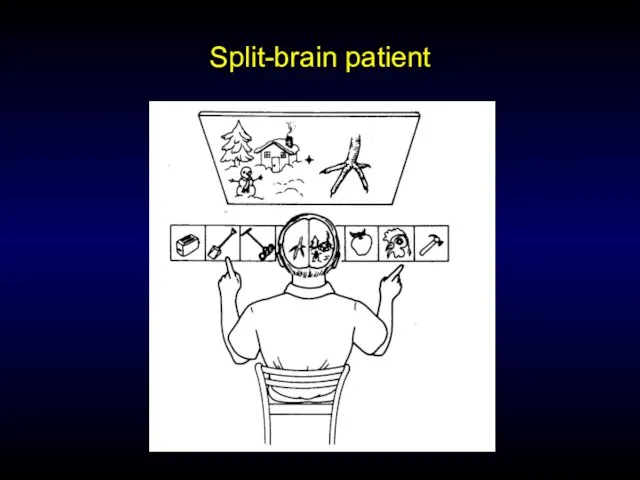 Split-brain patient