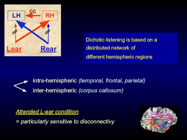 Dichotic listening is based on a distributed network of different hemispheric regions