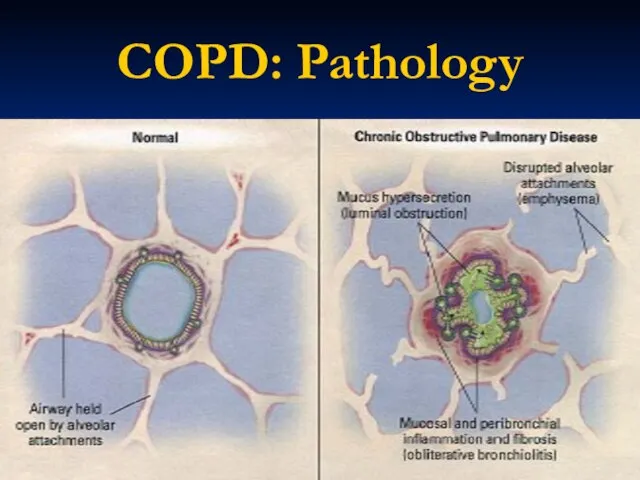 COPD: Pathology