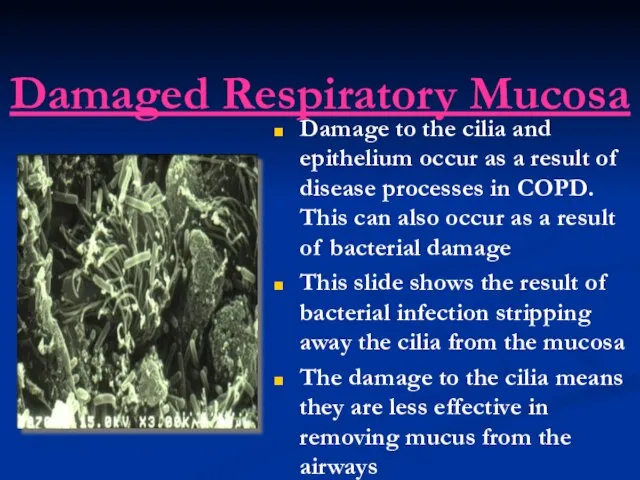 Damaged Respiratory Mucosa Damage to the cilia and epithelium occur as a