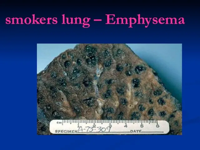 smokers lung – Emphysema