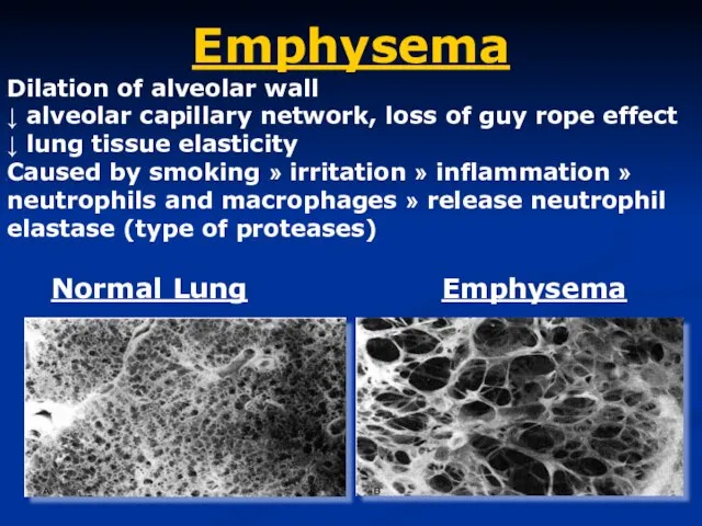 Emphysema Dilation of alveolar wall ↓ alveolar capillary network, loss of guy