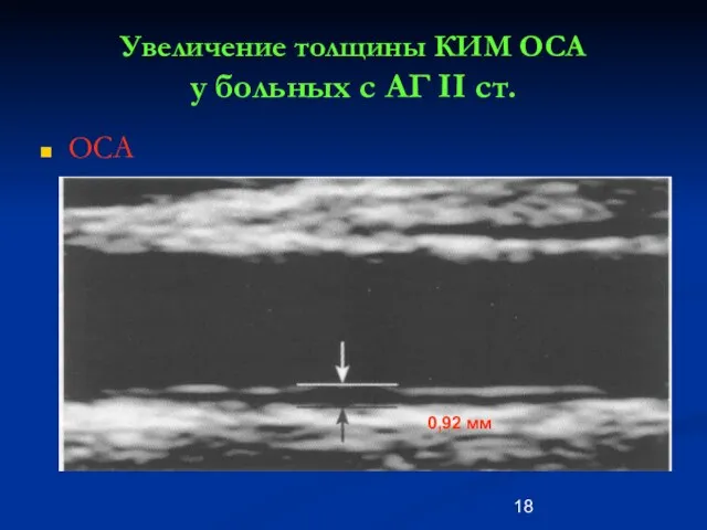 Увеличение толщины КИМ ОСА у больных с АГ II ст. ОСА 0,92 мм